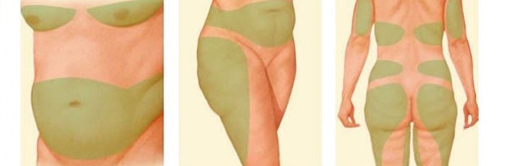 پیکرتراشی و جراحی لیپوماتیک